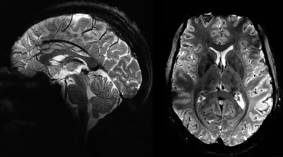 மனித மூளையை ஸ்கேன் செய்த சக்திவாய்ந்த எம்ஆர்ஐ இயந்திரம்! தெளிவுடன் படம் பிடிக்கப்பட்ட உயிருள்ள மூளையின் படங்கள் வைரல்!