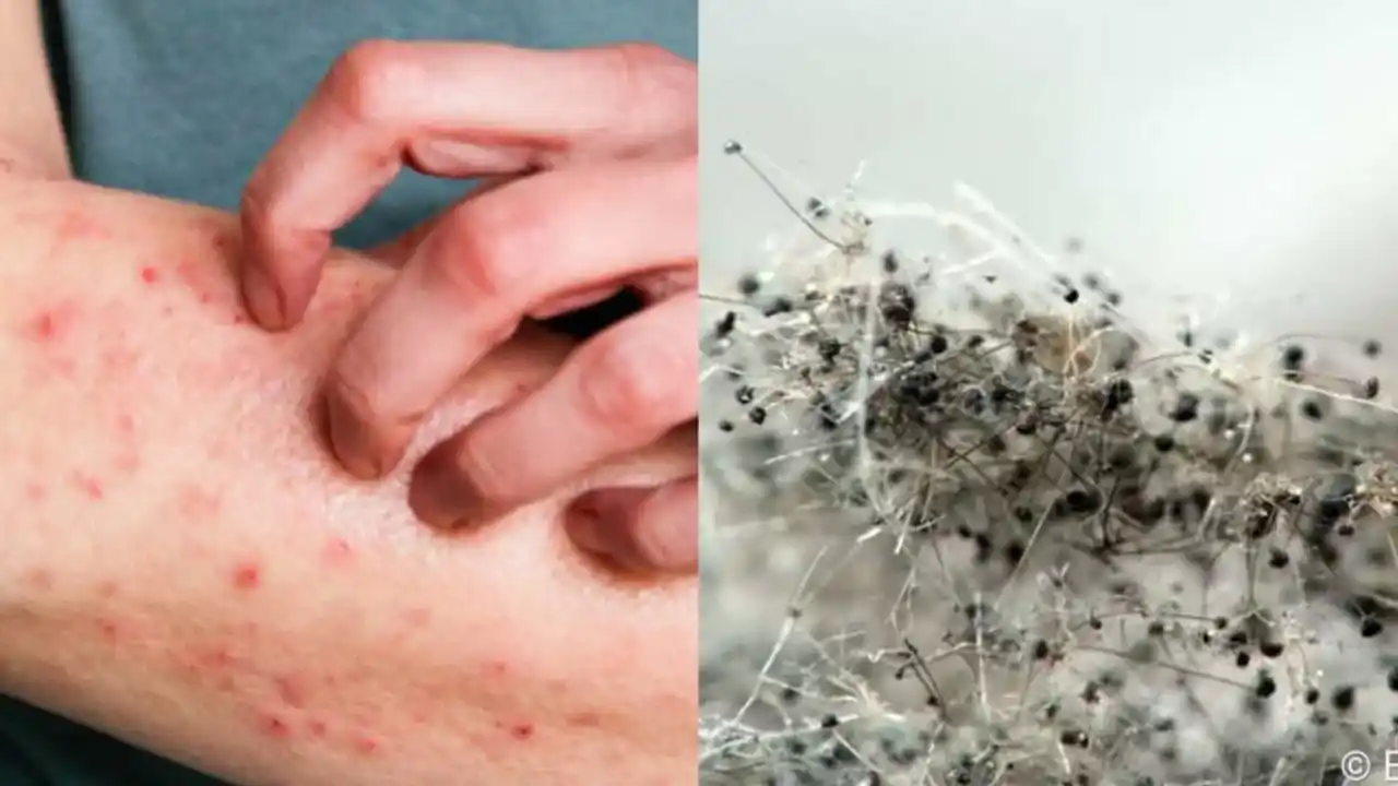 Aspergillus deadly fungus 11zon