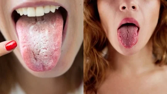 Tongue color