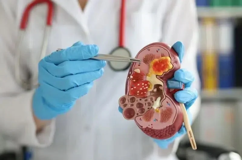kidney cancer