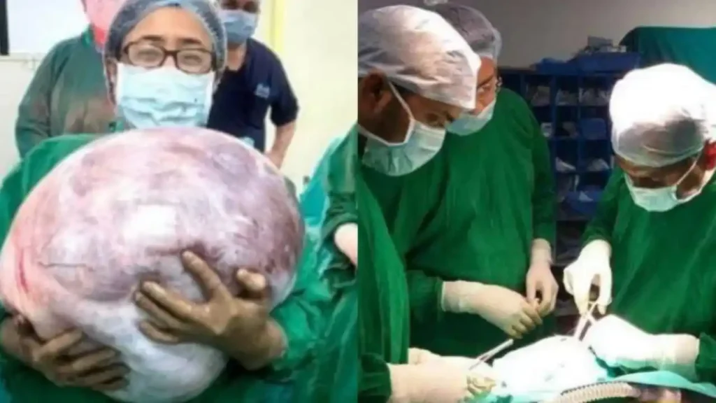 பெண்ணின் கருப்பையில் இருந்த 18 கிலோ கட்டி!. அறுவை சிகிச்சை மூலம் வெற்றிகரமாக அகற்றிய மருத்துவர்கள்!