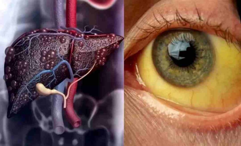 liver cirrhosis 11zon liver cirrhosis 11zon