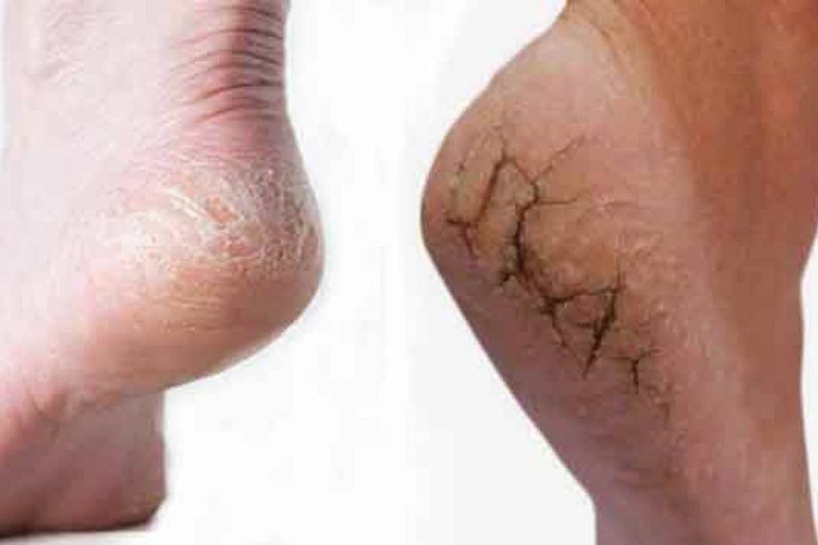 குதிகால் வெடிப்பு பிரச்சனையா?. இந்த எளிய வீட்டு வைத்தியங்களை பின்பற்றுங்கள்!