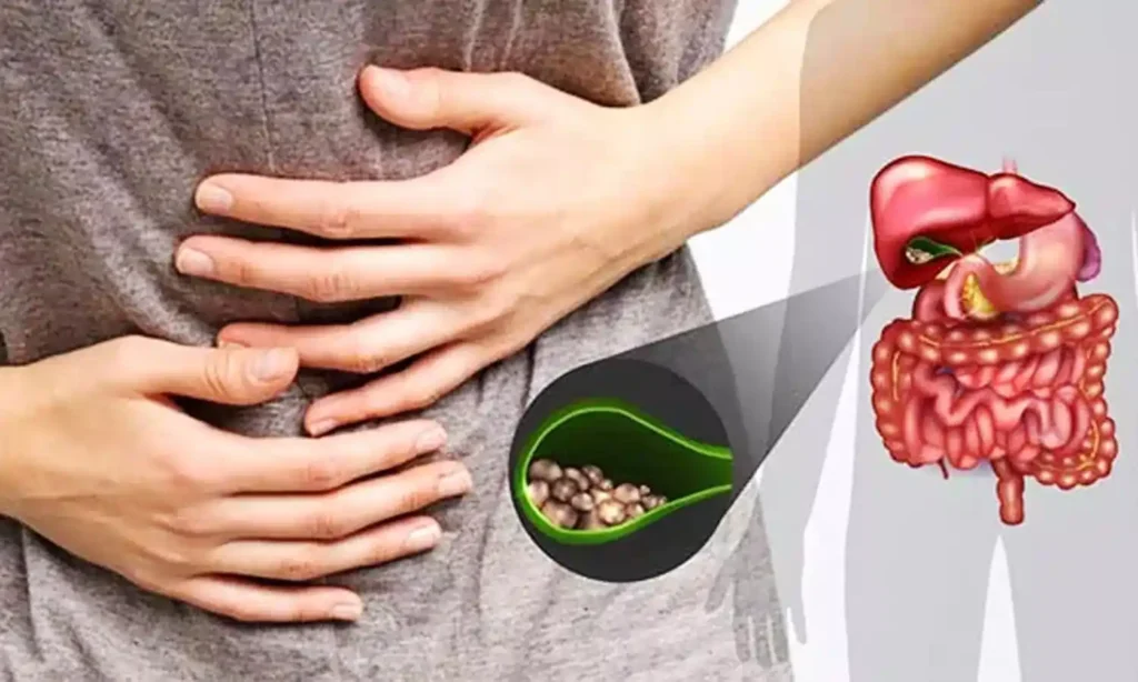 Gallstone 2025 Gallstone 2025