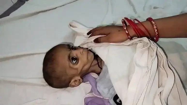 Malnutrition baby dies 11zon நாடே அதிர்ச்சி!. ஊட்டச்சத்து குறைபாட்டால் அடுத்தடுத்து இறக்கும் குழந்தைகள்!. மத்திய பிரதேசத்தில் சோகம்!