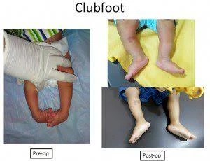 குழந்தைகளுக்கு ஏற்படும் பிறவிக்கால கிளப்-ஃபூட் நோய்…! 7 வாரத்தில் குணம்..! அசத்தும் ஜிப்மர்