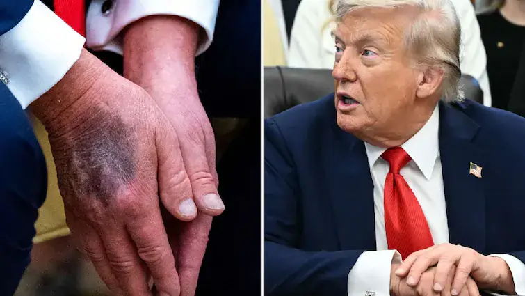 donald trump health issues 1