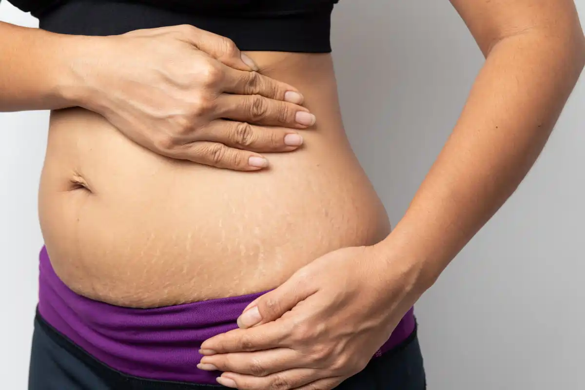 will a tummy tuck eliminate my stretch marks