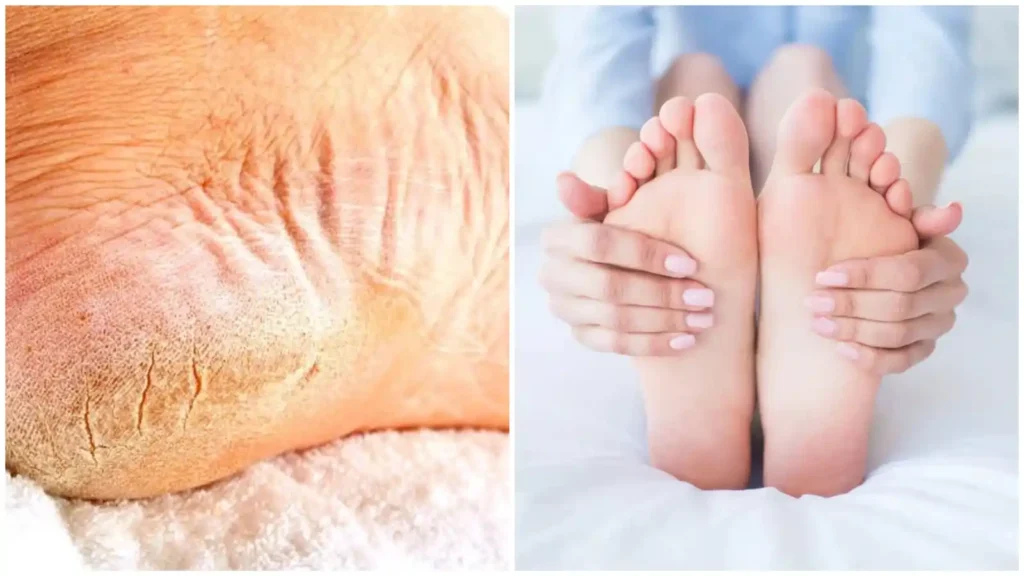 குதிகால் வெடிப்பு..!! நைட்ல இதை மட்டும் பண்ணுங்க..!! குழந்தைகள் பாதம் போல் மாறிவிடும்..!!