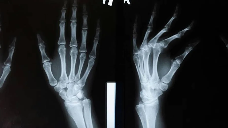 bone Wow! எலும்பு முறிவுகளை வெறும் 3 நிமிடங்களில் சரிசெய்யும் உலகின் முதல் ‘எலும்பு பசை’; சீன விஞ்ஞானிகள் அசத்தல் கண்டுபிடிப்பு!