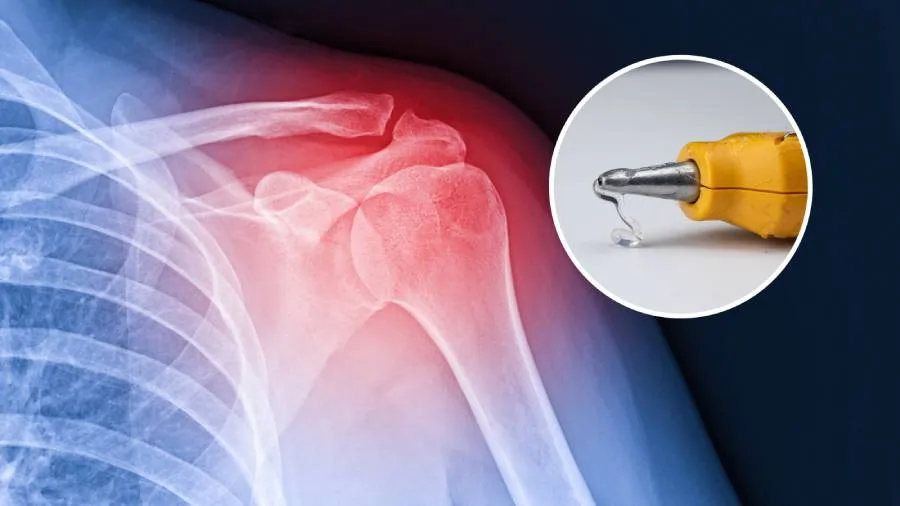 broken bones glue gun broken bones glue gun
