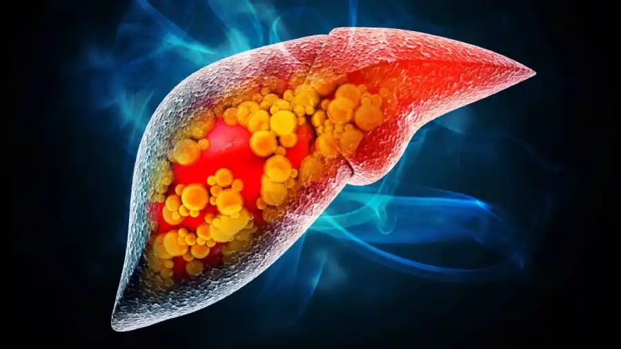 fatty liver fatty liver
