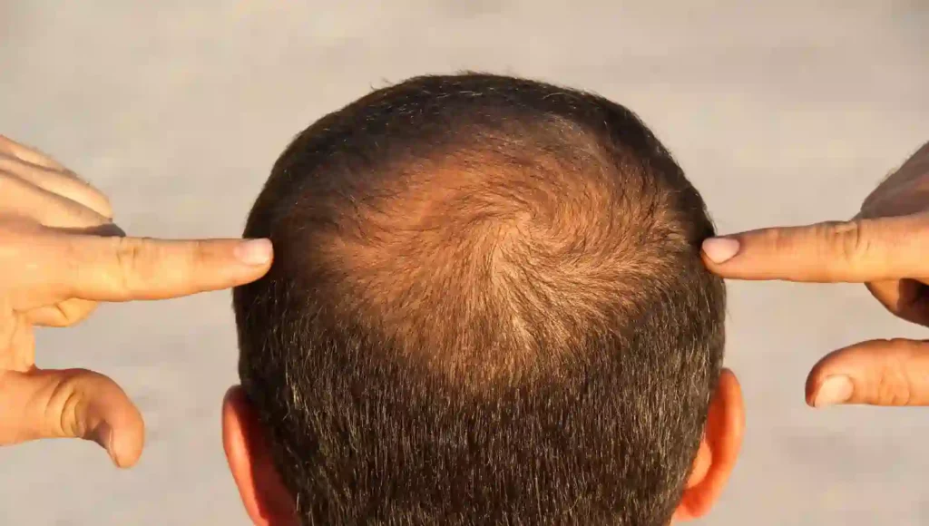 hair loss உங்களுக்கு திடீரென வழுக்கை விழுகிறதா?. மாரடைப்பின் அறிகுறியாக இருக்கலாம்!. மருத்துவர்கள் எச்சரிக்கை!