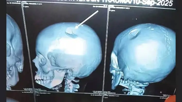 skull fracture 172413574 skull fracture 172413574