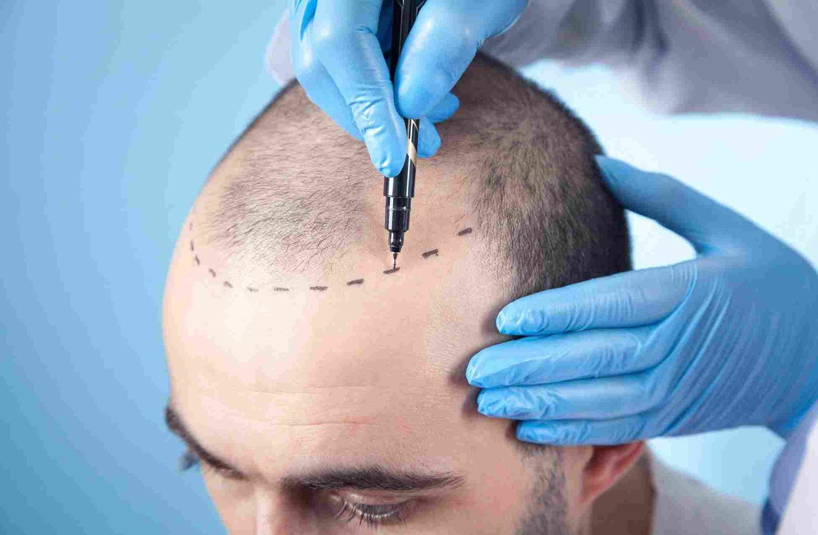 Hair Transplant 2026 Hair Transplant 2026