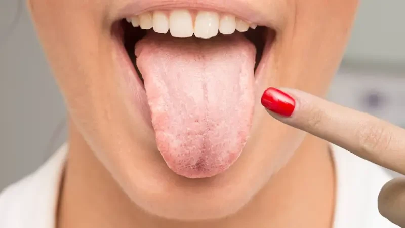 White tongue remedies