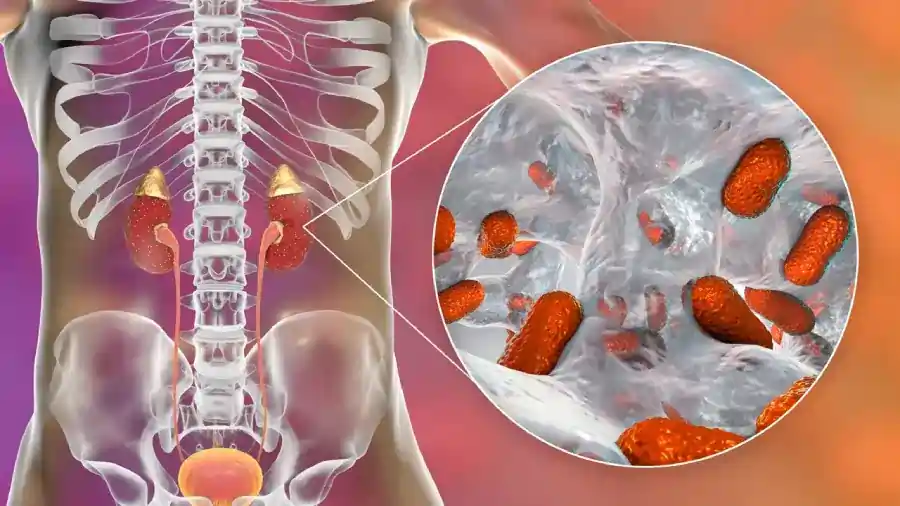 kidney infection 1 1