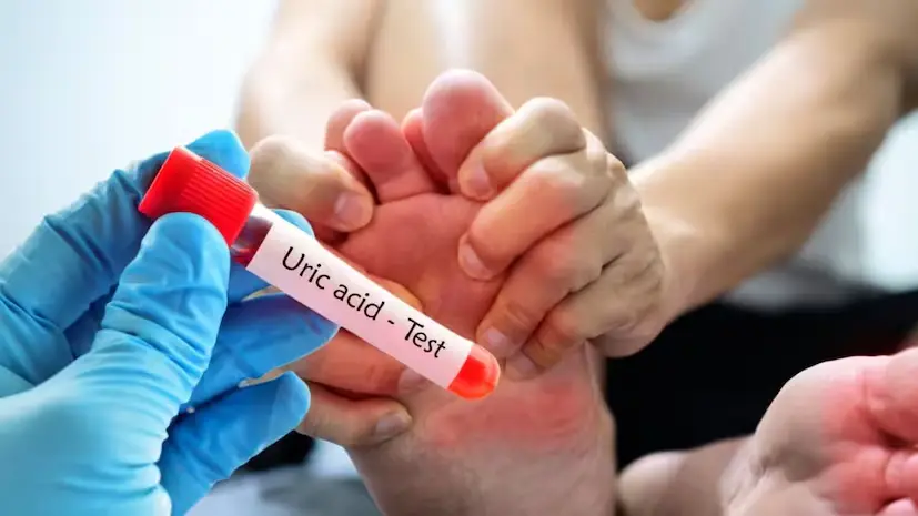 uric acid
