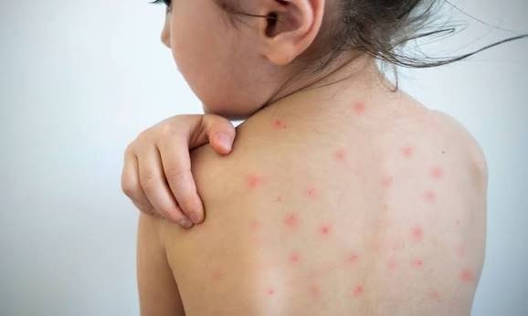 Measles